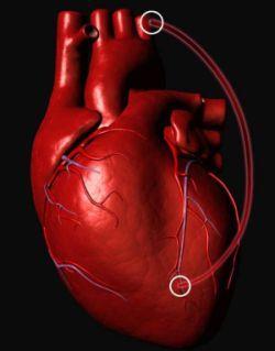 LIMITAÇÕES : DOENÇA CARDIACA > 75% dos sobreviventes de AVC tem doença cardiaca LIMITAÇÕES :