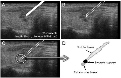 13 Figura 2: Ilustração esquemática da técnica de amostragem utilizada na thin core biopsy: a agulha de corte Menghini 21-G é inserida no nódulo (a); O mandril é removido (b); A agulha é avançada