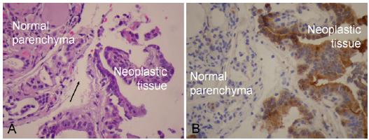 cápsula do nódulo quando presente (d). Fonte: NASROLLAH, N. et al. Thin core biopsy should help to discriminate thyroid nodules cytologically classified as indeterminate. A new sampling technique.