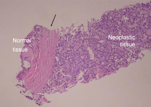 14 Figura 4: Amostra obtida por core biopsy de um nódulo encapsulado. A cápsula fibrosa (seta) separa a proliferação microfolicular neoplásica do parênquima circundante normal (coloração pela HE).