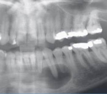 Por vezes podem impedir a erupção de dentes próximos ou mesmo ocorrendo a fusão entre o queratocisto e o folículo dentário, podendo ser confundido com um cisto dentígero (Serman, 1999).