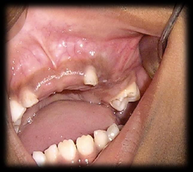 Uma das características mais importantes deste tipo de cisto é o facto da sua expansão ser assintomática (Scholl et al., 1999). Grande parte destes cistos são descobertos em radiografias de rotina.