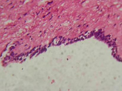 (Kumar et al., 2010) iv. Características Radiográficas A cavidade do cisto é quase sempre unilocular e nota-se a presença de um dente por erupcionar no interior da lesão (Han et al., 1995).