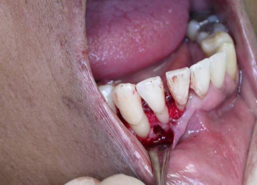 doença periodontal são possíveis, não se devendo ignorar o diagnóstico de cisto Periodontal Lateral (Nikitakis et al., 2010).