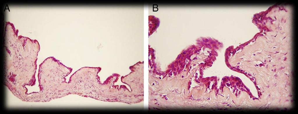 iii. Características Histológicas A avaliação do cisto revelou existência de uma camada fina de células (1-5 células) de epitélio escamoso estratificado cubóide não-queratinizado, muitas vezes com