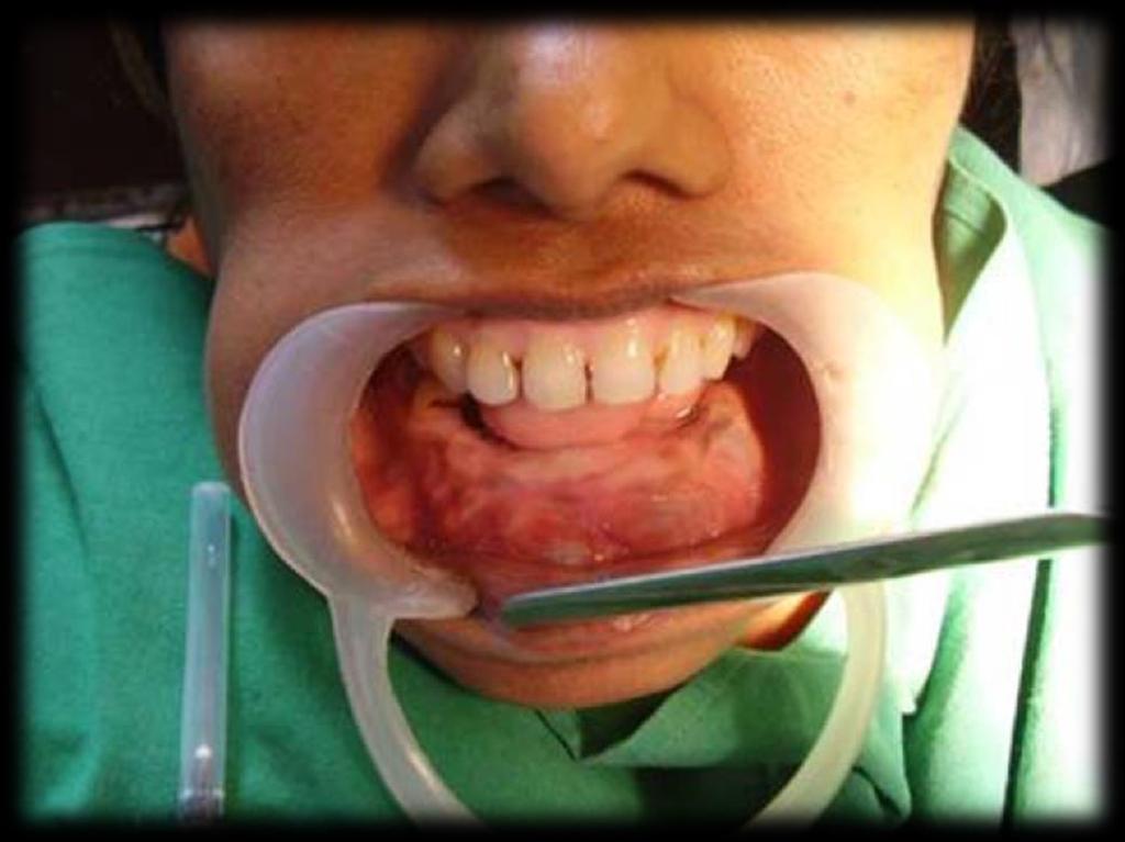 ii. Características Clínicas A lesão situa-se mais comumente na região anterior da mandíbula possuindo um comportamento agressivo (Tambawala et al., 2014; Turalı et al.
