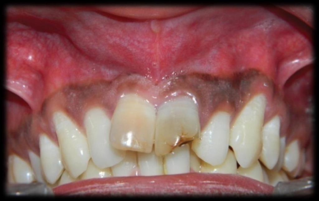 Podem apresentar expansão cortical, reabsorção das raízes dos dentes associados e deslocamento dos dentes adjacentes (Kadam et al., 2014).