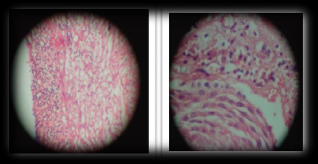 iii. Características Histológicas A natureza do revestimento epitelial varia em relação ao estágio de desenvolvimento do cisto e à severidade da inflamação.