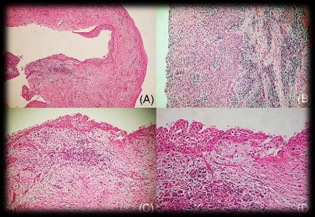 morfologias, dependendo da extensão da inflamação (Lacaita et al., 2006; Morimoto et al., 2004; Martinez-Conde et al., 1995; Prakash et al., 2012).