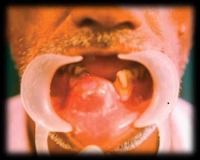 encontrados no ramo mandibular em pacientes cuja idade seja superior a vinte anos. (Sridevi et al., 2014). São na maior parte intraósseos (Jamdade et al., 2012).