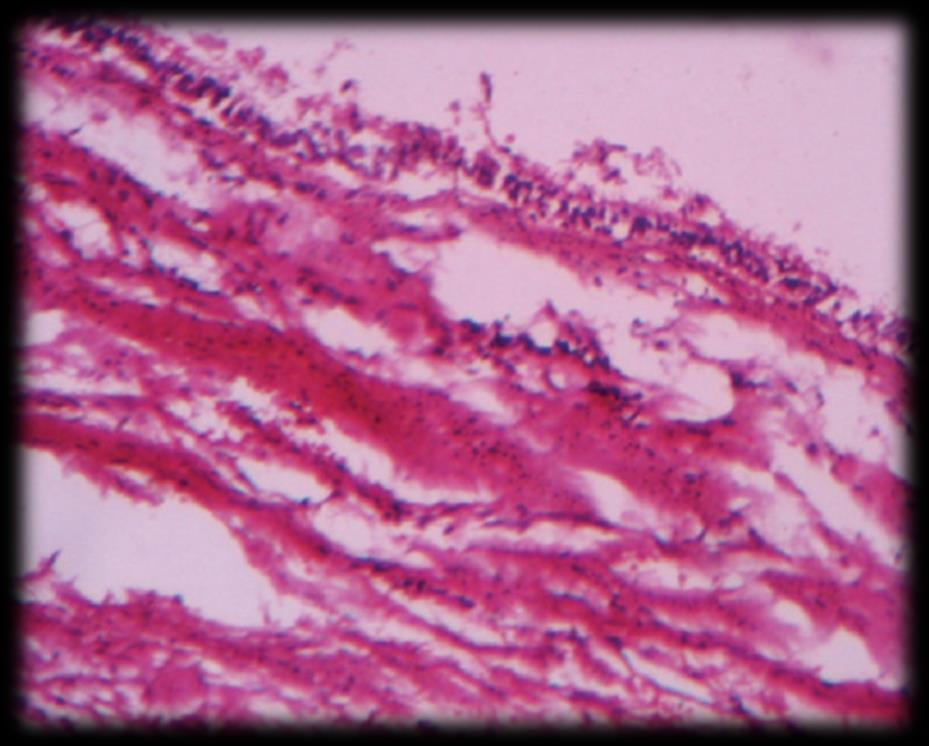 O epitélio é escamoso estratificado disposto num padrão de arcada, revestindo a cavidade cística O tecido conjuntivo da parede apresenta focos de calcificação. (Sridevi et al., 2014).