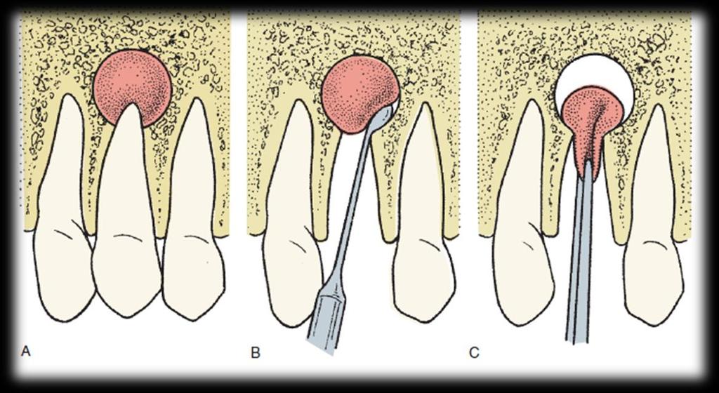 A grande vantagem passa pela análise histológica da totalidade do cisto, sendo que a própria biópsia excisional inicial pode também servir para tratar a lesão na íntegra.