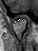 coronal em T1 apresentando OA do tipo degenerativa (erosão) na superfície óssea do