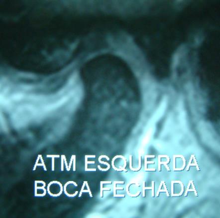 110 Imagens V e VI - ATM esquerda de voluntário exposto sem DTM em um plano sagital mediano em T1 apresentando o disco em sua posição superior e OA do tipo adaptativa (aplainamento) na superfície