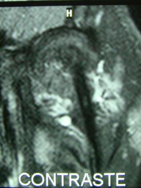 Imagem XI Efusão líquido sinovial dentro da cápsula articular da ATM direita em um plano coronal em