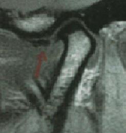 Imagem XVI - ATM apresentando contornos regulares da superfície óssea do côndilo.