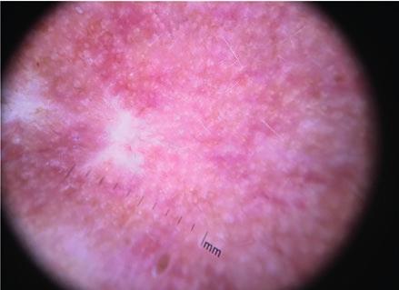 O infiltrado denso de células inflamatórias polimorfas localiza-se nos 2/3 superiores da derme e observa-se frequentemente uma zona de Grenz (região subepidérmica) proeminente.