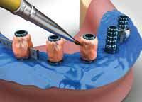 Distal nos implantes posteriores.
