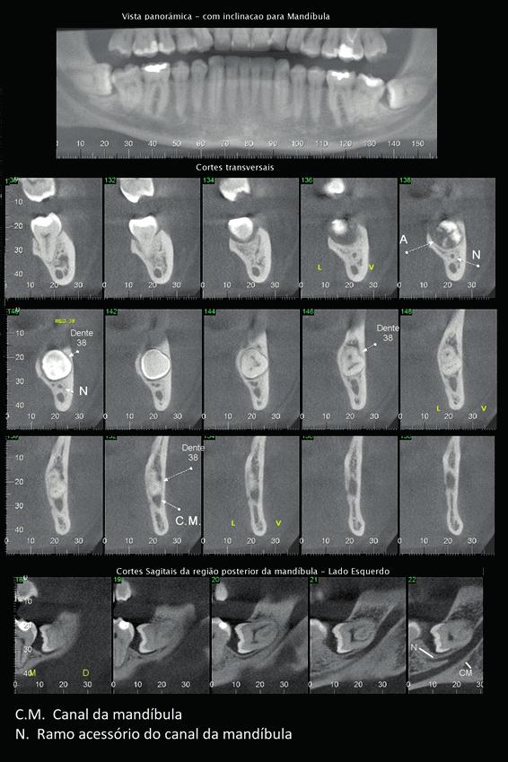 Cortes tomográficos transversais e sagitais evidenciando a