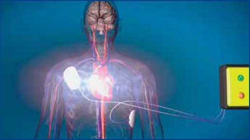 A parada cardíaca súbita ocorre quando os impulsos elétricos normais do coração se tornam subitamente desorganizados.