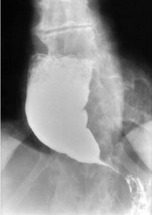 OUTROS EXAMES: Radiografia simples do tórax ausência de ar no estômago hipotransparência mediastinal ao lado da aorta nível hidroaéreo mediastinal Esofagografia baritada dilatação