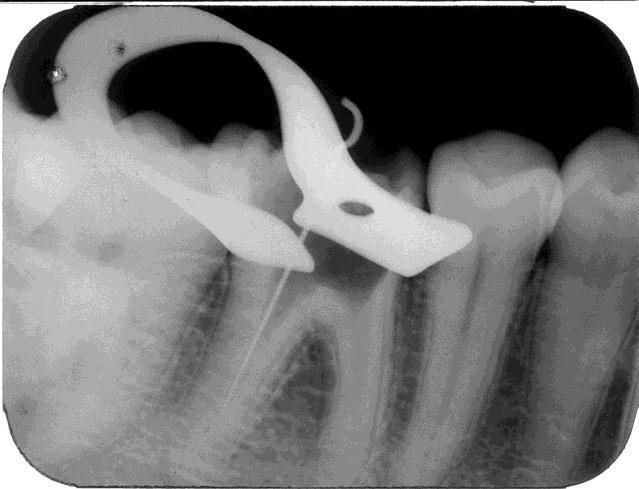 4) foi aquele que radiograficamente aparentava seguir a luz do canal distal.