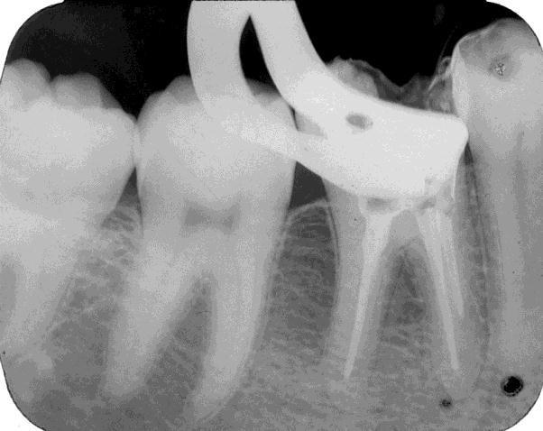 Entre a primeira sessão na clínica de Especialização em Endodontia e a última, quando foi realizada obturação dos canais do elemento 46, transcorreu-se um período de um ano, podendo-se perceber