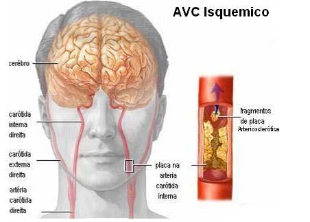 CONCEITO O Ataque Isquêmico transitório (AIT) é definido como déficit neurológico decorrente de isquemia cerebral focal que regride em