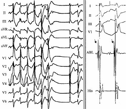 Mapping and Ablation of Ventricular Fibrillation Associated With Long-QT and Brugada Syndromes