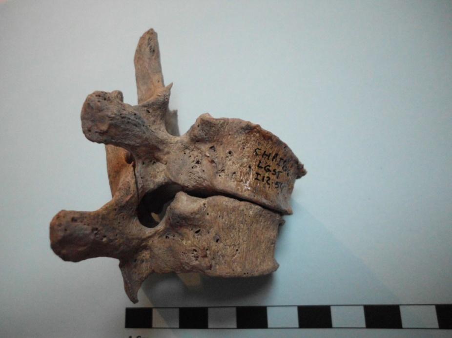 Figura 9- Vértebras torácicas (T8 e T9) do indivíduo 12, exumado do largo de Santiago, (sexo masculino) que evidencia