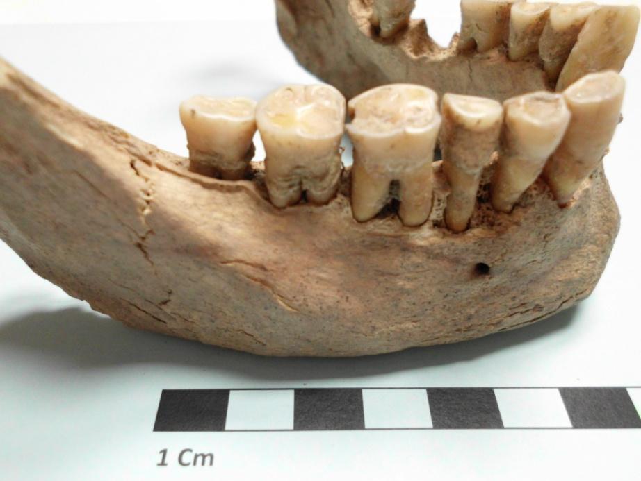 Figura 21- Mandíbula do indivíduo 20 exumado da rua Silva Gouveia, do sexo masculino, com evidências de doença periodontal e presença de cálculo dentário nas raízes.