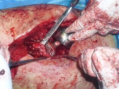 Limpeza do campo Tempo cirúrgico Lavagem da ferida Técnica atraumática Proteção do ciático