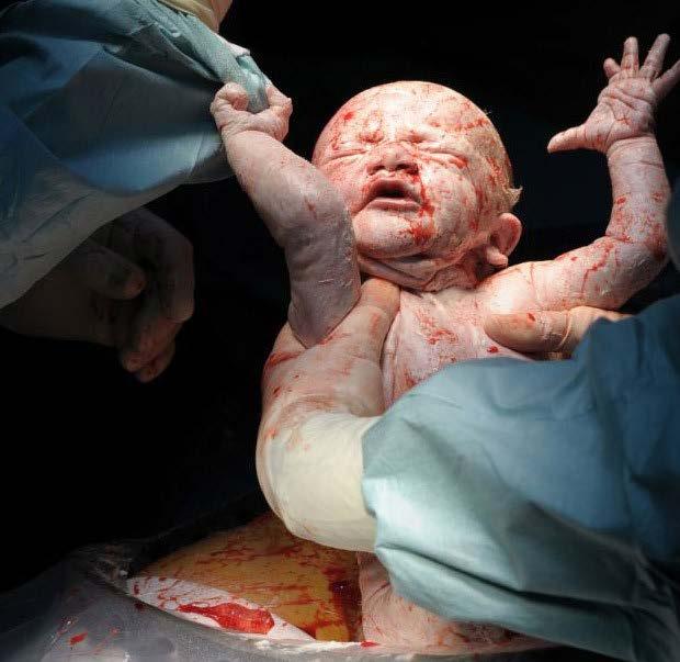 Segundo a OMS, estimase que apenas 10% a 20% dos partos têm indicação cirúrgica.