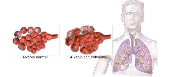 Complicações: Enfisema pulmonar; Insuficiência respiratória