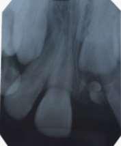 da unidade, sendo necessário tracionamento ortodôntico desse elemento dentário. 2. Relato de Caso Paciente R.V.S.