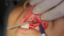 tamanho médio na face vestibular do dente, liberando uma força de 50 mg/força O retalho cirúrgico