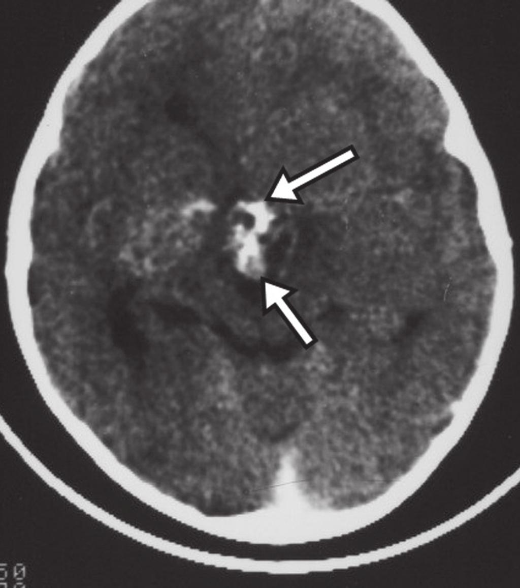 O diagnóstico diferencial que se impõe com essas lesões é sempre o craniofaringioma. A ausência de calcificações reforça a possibilidade diagnóstica de cisto da bolsa de Rathke (6). Figura 4.