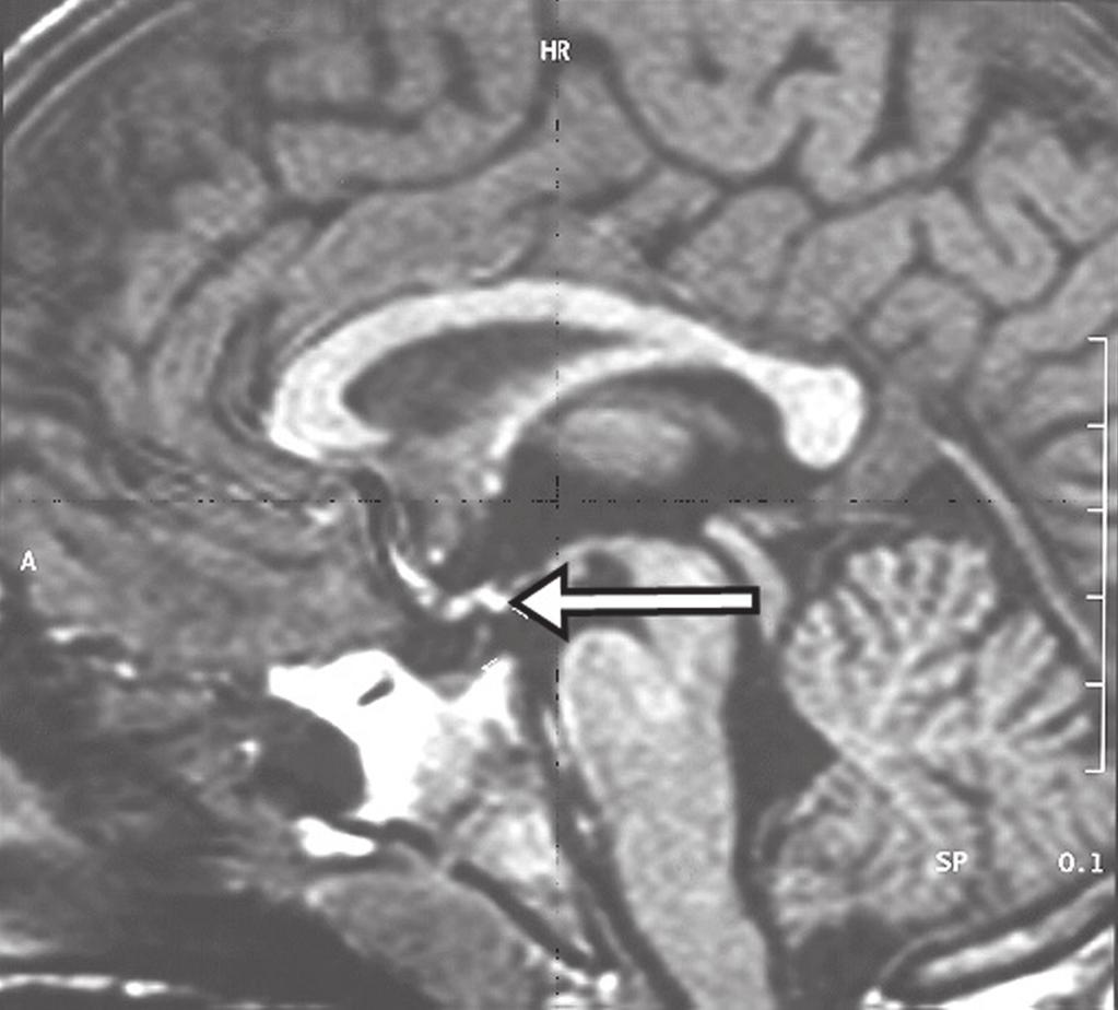 Figura 18. Ponderação em T1 no plano sagital identificando neuro-hipófise ectópica (seta) em paciente com déficit idiopático de hormônio de crescimento.