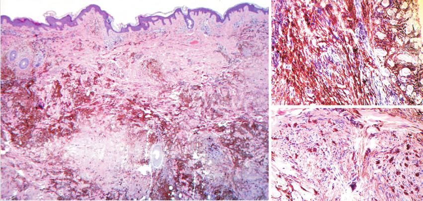 B A C Fig 4 - Histologia da lesão demonstrando proliferação melanocítica intradérmica, fusocelular e dendrítica com sobrecarga pigmentar (A) num estroma esclerótico, compatível com nevo azul comum
