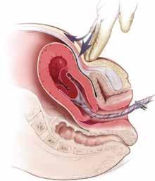 função dos riscos associados à sua realização intempestiva, como rompimento do cordão umbilical e inversão uterina. Figura 1.