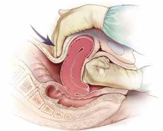 4.2 Tratamento não cirúrgico 4.2.1 Massagem uterina bimanual A Manobra de Hamilton é a primeira manobra a ser realizada nos casos de atonia uterina, enquanto se realiza o uterotônico e aguarda-se o seu efeito (Figura 4).