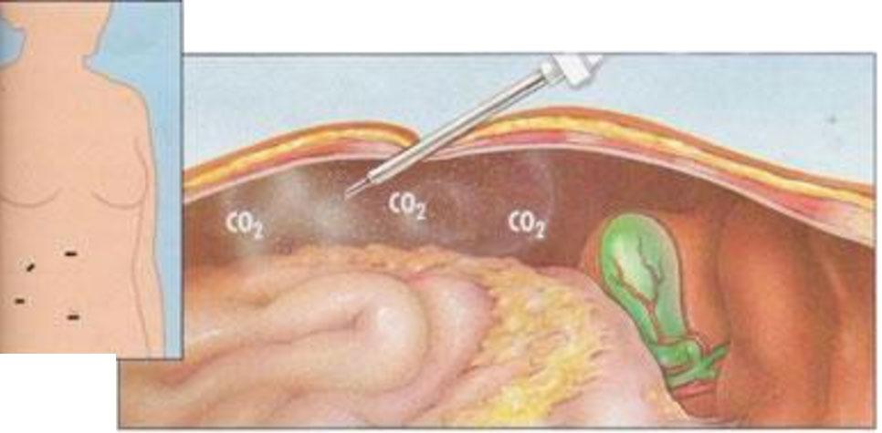 Procedimento Vantagens CO 2 (maior absorção em líquidos orgânicos diminuindo a dor infra escapular no pós-operatório causada pelo acumulo de gás na cavidade, não ser explosivo, etc.