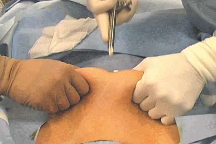 Procedimento Anestesia o paciente Posiciona o paciente conforme o procedimento Antissepsia da pele Cobertura com campos estéreis Aproximação do sistema de vídeo (de frente para o cirurgião) Conexão