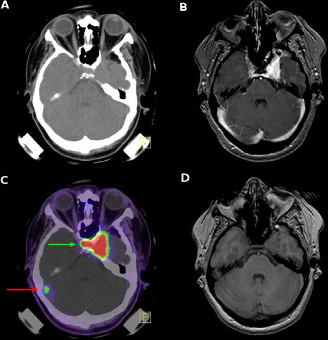 Ga-DOTATOC PET/CT and contrast-enhanced MRI Eur J Nucl Med