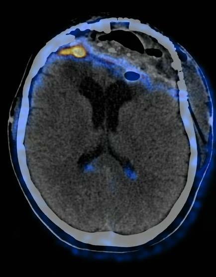 em Meningiomas