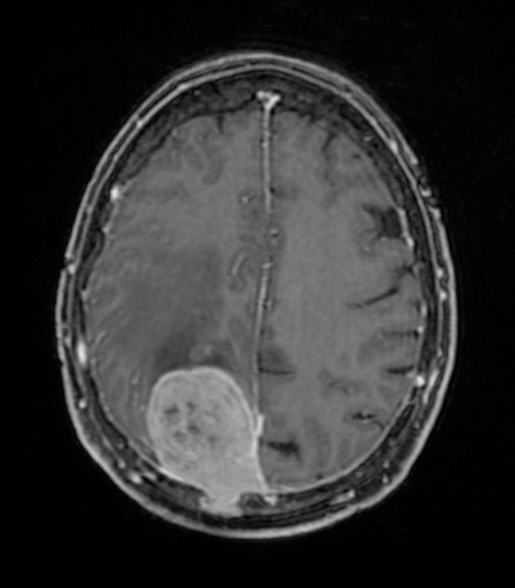 Meningiomas Metabolismo