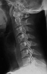 Choque medular Definição: Spinal Cord