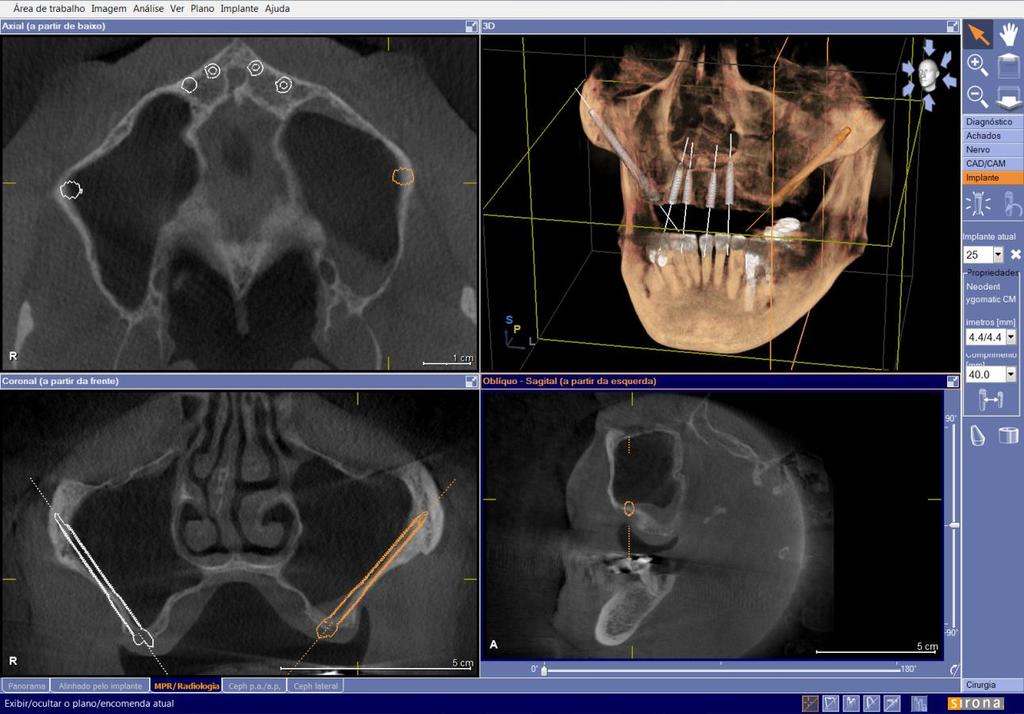 37 Figura 1 Simulação de planejamento virtual de implante zigomático bilateral em paciente desdentado superior, no software Galileos Implant