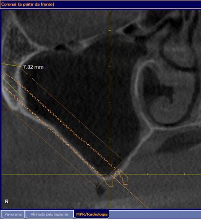 4.2 Classificação dos tipos de concavidades maxilo-sinusais A concavidade formada entre a crista do rebordo alveolar, parede lateral do seio