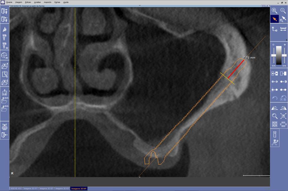 39 As medidas (denominadas B-JU) de comprimento da porção apical do implante que permanece em contato com o osso zigomático (ancoragem apical) foram obtidas